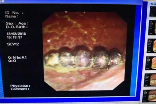 21个月宝宝误吞纽扣电池，胃镜下手术成功取出！