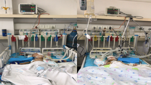 长春市儿童医院完成东北三省首例伴有重度心衰的室间隔缺损修补手术