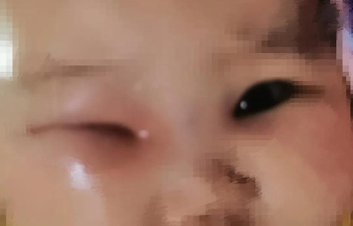 长春5月龄宝宝眼睛总“水汪汪”，一查是这病！