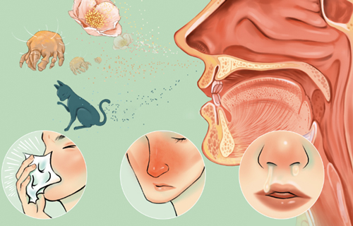 全国爱鼻日 | 专家教您如何预防过敏性鼻炎
