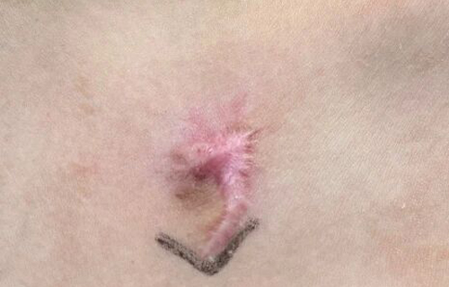 出生后颈部有孔？这是先天性疾病——鳃裂瘘管！